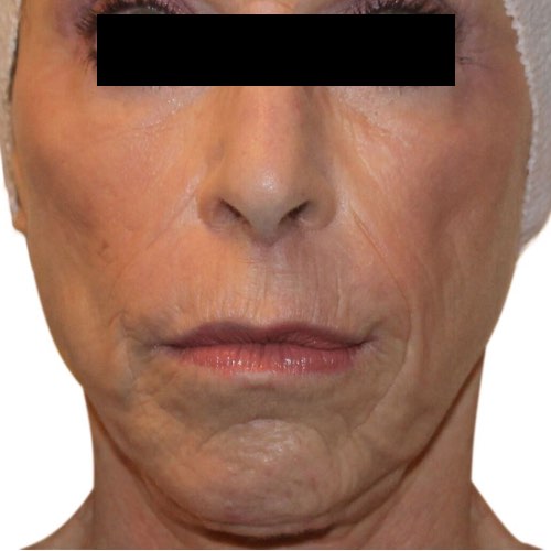 VDP wrinkle reduction 1 after