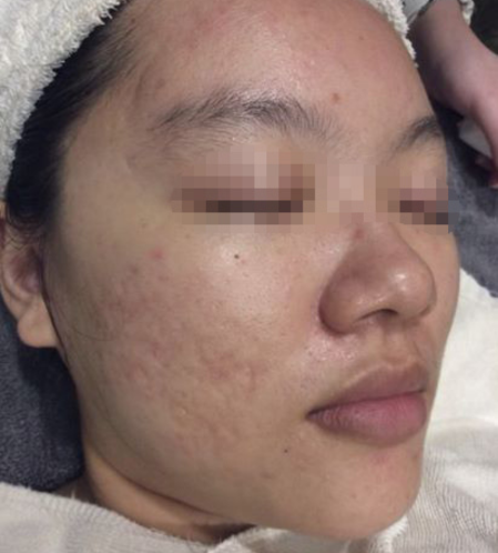 acne skin after