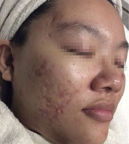 acne skin before
